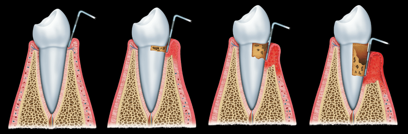 Entwicklung einer Parodontose - Stadien und Behandlungen in der Parodontologie Bochum