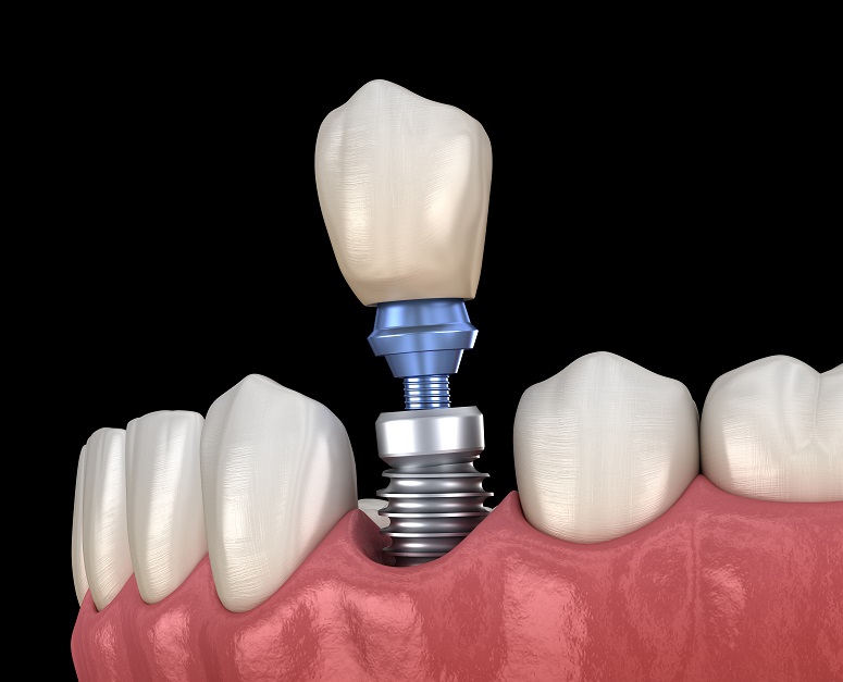 Implantat Zahn