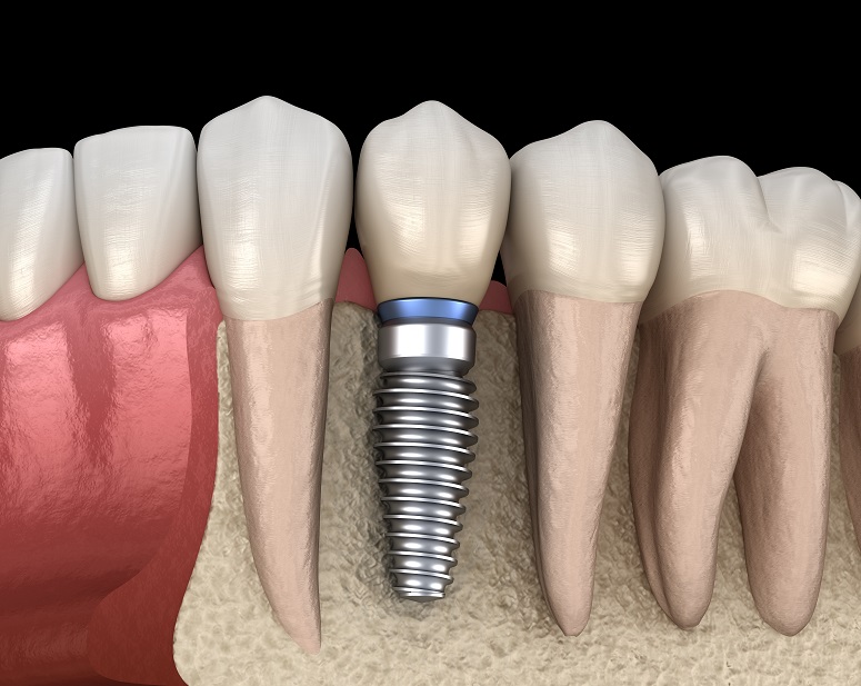 Festsitzender Zahnersatz: Implantat im Kieferknochen
